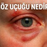 Göz Uçuğu Nedir?